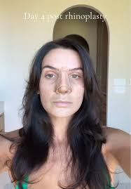 Día 4: Actualización de rinoplastia tras la cirugía