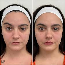 This beautiful client felt that it was time to take the jump into the world  of filler!💉Her biggest concern was the hollowing in her under eyes. So we  treated her midface for