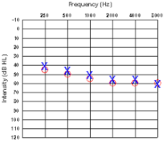 Degrees Of Hearing Loss