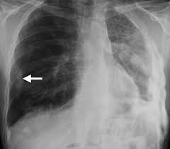 Asbestosis is a type of. Multimodality Imaging For Characterization Classification And Staging Of Malignant Pleural Mesothelioma Radiographics