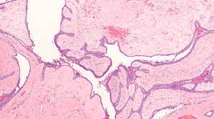 Phyllodes tumors are an uncommon type of fibroepithelial neoplasm of the breast and present on a morphologic continuum from benign to malignant. Trending With Impact Benign Borderline And Malignant Breast Tumors Oncotarget