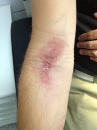 Image result for Photodermatitis