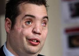 Brave blinded soldier has Union Flag glass eye