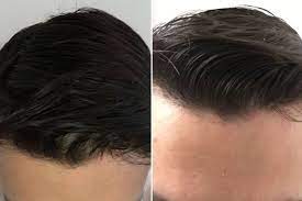 Ways of the problem solution. Vampire Hairlift Is Bloody Newfangled Treatment Balding Brits Are Counting On But Does It Work Mirror Online