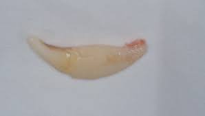 Image result for Tooth Avulsion