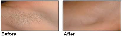 Laser hair removal uses a laser light source to target pigmented hair, destroying the follicle with heat while electrolysis destroys the hair follicle through preoperative preparation for laser hair removal requires a pretreatment consultative visit to determine eligibility. Laser Hair Removal Nyc Hair Removal Manhattan