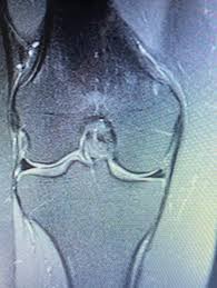 Typische meniskus symptome für einen innenmeniskus anriss sind eher knieschmerzen bei der außenrotation. Ist Das Ein Meniskusriss Computer Knie Mrt