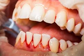 When it comes to oral health, your teeth shouldn't be your only focus. Healthy Gums Don T Bleed Your Dentists In Asheville Nc