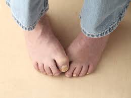 Any variety may be used in a vinegar cure for toenail fungus. Cure Toenail Fungus Naturally Home Remedies To Treat Toenail Fungus Nail Fungus Treatment