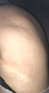 Vil det skadde vevet/ arret danne bindevevsceller, fibroplaster. Ann Linda 16 Ar Og 2 Nye Hofteproteser