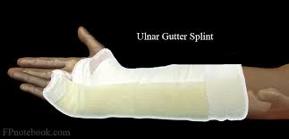 Image result for Radial Gutter Cast