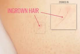 But nothing ruins all that effort like ingrown hairs. How To Prevent Ingrown Hairs With These 7 Effective Hacks Prevent Ingrown Hairs Ingrown Leg Hair Ingrown Hair