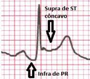 Jun 30, 2017 · a presença de dor torácica deve ser caracterizada como aguda ou pleurítica. Pericardite Aguda Saiba Mais Sobre A Etiologia Desordens Reumatologicas Quadro Clinico E Tratamento Dessa Inflamacao Do Pericardio