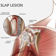 Arthroscopic Labrum Repair Of The Shoulder Slap And Return To Sport Shoulder Anatomy Shoulder Surgery Arthroscopic Shoulder Surgery