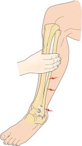 Image result for Ankle External Rotation Test