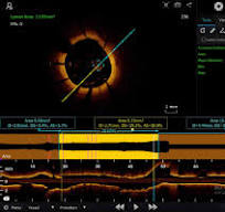 Vivolight Medical to Debut P80-E OCT System at TCT 2025 in ...