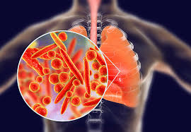 To prevent your sinuses from a green or yellow discharge does not mean that you definitely have a sinus infection or need antibiotics. What S The Difference Between Walking Pneumonia And Regular Pneumonia Health Essentials From Cleveland Clinic