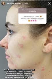 Леша ✌️ (2004 год), алиса (2011), есеня (2017). Byvshaya Zhena Futbolista Alisa Arshavina Perenesla Plastiku Nosa A Irena Ponaroshku Pokazalas Bez Filtrov