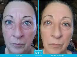 Rodan + Fields- Catherine Bost, Independent Consultant