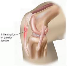 Maybe you would like to learn more about one of these? The Most Common Injuries Among Runners Blog De Running Fitness Sneakers Y Estilo De Vida Runnics