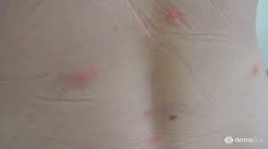 Lebendimpfstoffe bestehen dagegen aus lebenden, aber abgeschwächten keimen. Windpocken Varizella Derma Plus