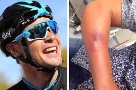 Nicolas Roche's training interrupted by hospital visit after infected  spider bite
