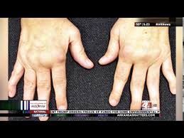 KARK: Dr. Sruthi Kanuru Discusses Wilma Shaw's Journey with Rheumatoid  Arthritis