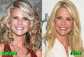 The stigma surrounding plastic surgery is disappearing as more mothers share their experiences, and why surgery was right for them. Christie Brinkley Before And After Cosmetic Surgery Plastic Surgery Mistakes