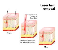 Are you new to laser hair removal? How Does Laser Hair Removal Work