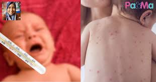 Campak merupakan jenis penyakit infeksi yang muncuk karena adanya sebuah virus, campak ini apalagi untuk anak kecil, pada anak kecil biasanya campak akan lebih mudah menular ketimbang. Bayi Tumbuh Ruam Lepas Demam Doktor Terangkan Jenis Cara Penjagaan Paling Penting Mesti Rawat Segera Pa Ma