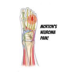 Morton S Neuroma Self Help Tips Treatment And Prevention From The Barefoot Running Doctor At Team Doctors Team Doctors Blog Athlete For Life