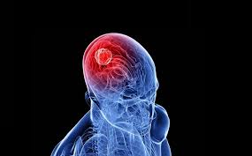 Una enfermedad neurodegenerativa que no tiene cura. Que Es El Ela Y Como Se Cura Esta Enfermedad