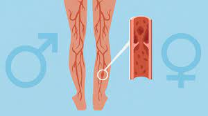 How To Prevent Blood Clots In Pregnancy | Everyday Health