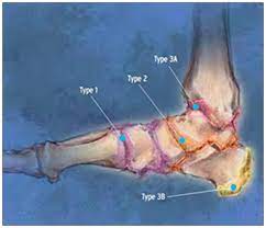 Charcot Ankle Neuroarthropathy Pathology Diagnosis And Management A Review Of Literature Medcrave Online