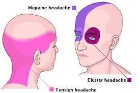 Causes Severe Headaches Types Of Headaches Types Of