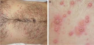 Hunter handsfield, md, a spokesperson for the american sexual health association and professor emeritus. Figure 1 From Disseminated Primary Herpes Simplex Virus Type 2 Infection In A 22 Year Old Male Semantic Scholar