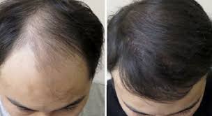 Cara termudah adalah rajin menggunakan masker rambut minimal dua kali seminggu. Cara Melebatkan Rambut