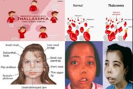 Cara Mengatasi Penyakit Thalasemia Paling Mujarab Dan Alami By Tama Dewi