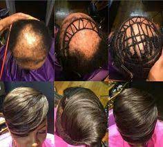 Hair is an integral part of how we define ourselves and to go without it. 91 Alopecia Ideas In 2021 Alopecia Hairstyles Alopecia Natural Hair Styles