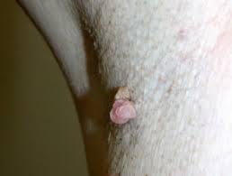 Carrie madormo, rn, mph, is a freelance health writer with over a decade of experience working as a reg. Skin Tag Dermnet Nz
