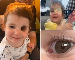 Successful cleft lip and palate repair surgery