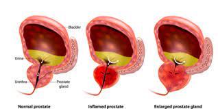 69% reduction among all cancer patients. How To Reduce Prostate Cancer Risk And Ensure Low Psa Levels The Guerrilla Diet