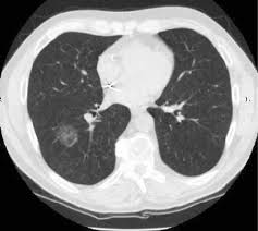 Learn vocabulary, terms and more with flashcards, games and other study tools. A Classification Of Pulmonary Nodules By Ct Scan Ecancer