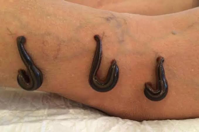 Raktamokshan and leech therapy product image