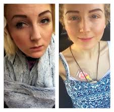 Four Years Ago I Had Strabismus Surgery To Straighten My Eyes This Is The Difference Http Ift Tt 2uubwnv Strabismus Surgery Surgery Eyes