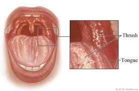 Image result for oral thrush symptoms roof of the mouth