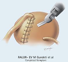 Libro el libertino invisible es uno de los libros de ccc revisados aquí. Robotic Paediatric Urology Orvieto 2012 Bju International Wiley Online Library