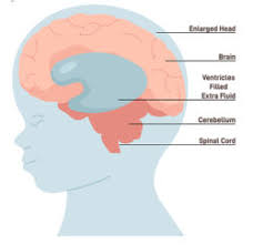 Image result for Hydrocephalus