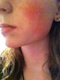Theanswerhub is a top destination for finding answers online. How To Get Rid Of Natural Red Cheeks Not Rossia Beautylish