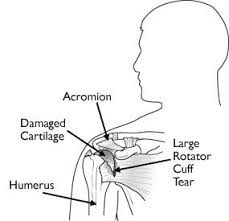 Rotator cuff injury can often be treated using therapies such as physiotherapy and medication. Arthritis Of The Shoulder Orthoinfo Aaos